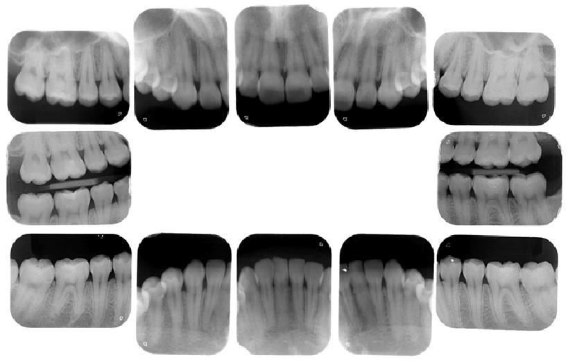 口腔内全体のレントゲン